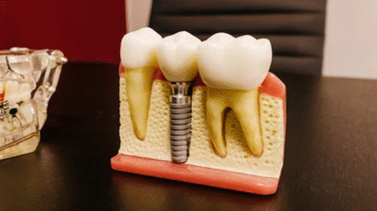 dental implant